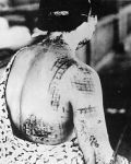 310px-The_patients_skin_is_burned_in_a_pattern_corresponding.jpg